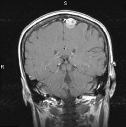 出國治療腦膜瘤哪個醫(yī)院好?德國INI腦膜瘤手術實例交流